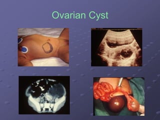 Ovarian Cyst
 
