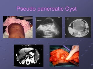 Pseudo pancreatic Cyst
 