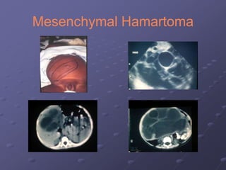 Mesenchymal Hamartoma
 