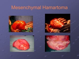 Mesenchymal Hamartoma
 