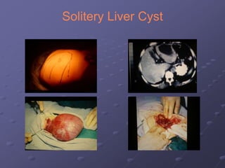Solitery Liver Cyst
 