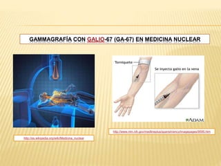 GAMMAGRAFÍA CON GALIO-67 (GA-67) EN MEDICINA NUCLEAR
http://es.wikipedia.org/wiki/Medicina_nuclear
http://www.nlm.nih.gov/medlineplus/spanish/ency/imagepages/9595.htm
 