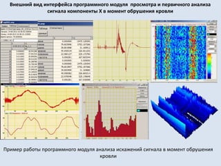 Пример работы программного модуля анализа искажений сигнала в момент обрушения
кровли
Внешний вид интерфейса программного модуля просмотра и первичного анализа
сигнала компоненты Х в момент обрушения кровли
 