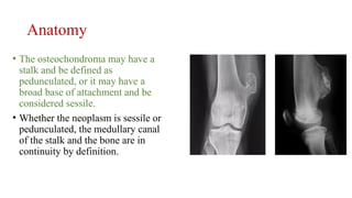 SOLITARY OSTEOCHONDROMA.pptxorthopaedics | PPTX