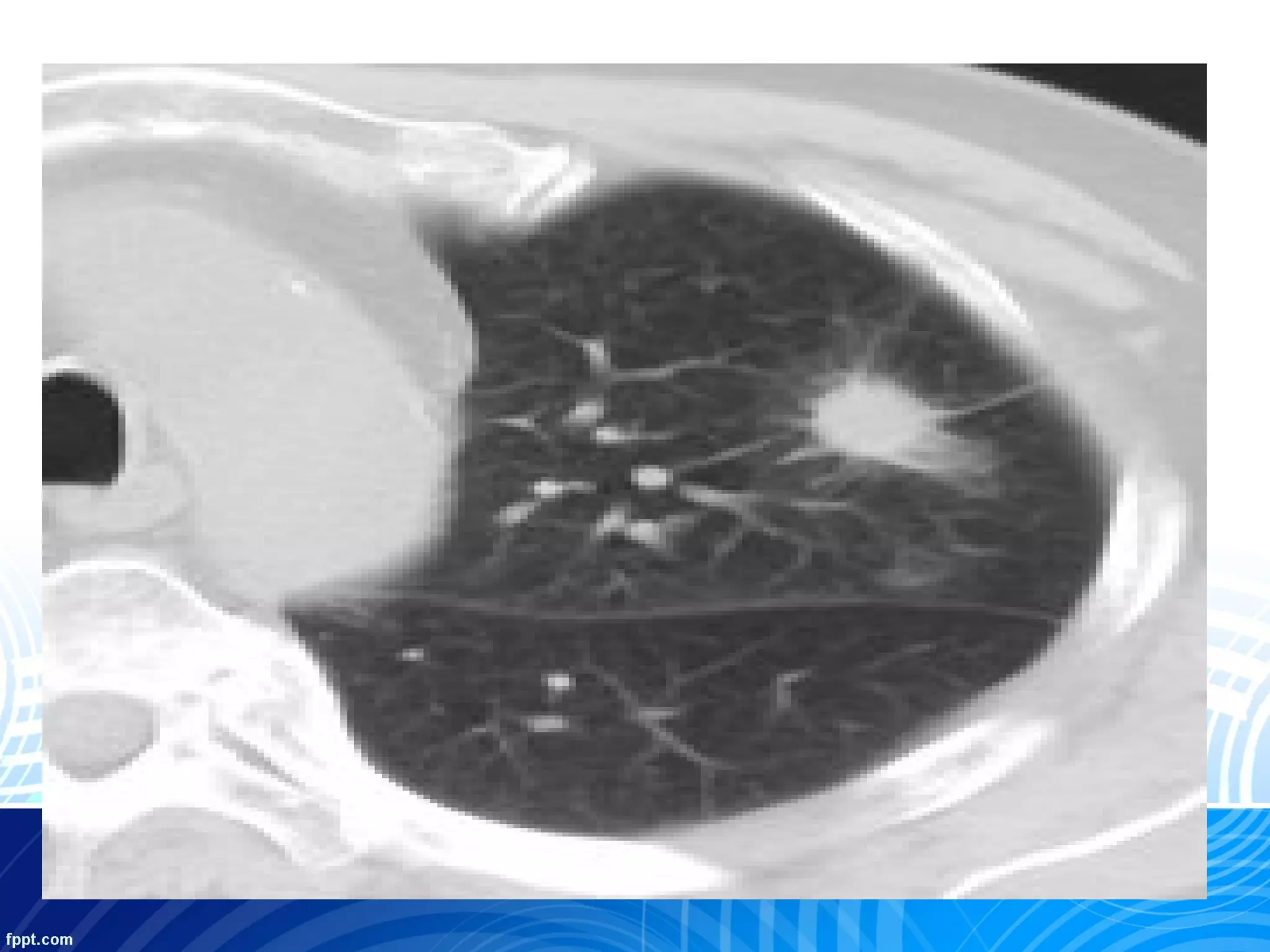 Solitary pulmonary nodule | PPT