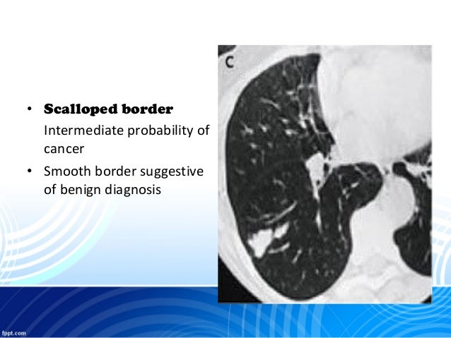 Solitary pulmonary nodule