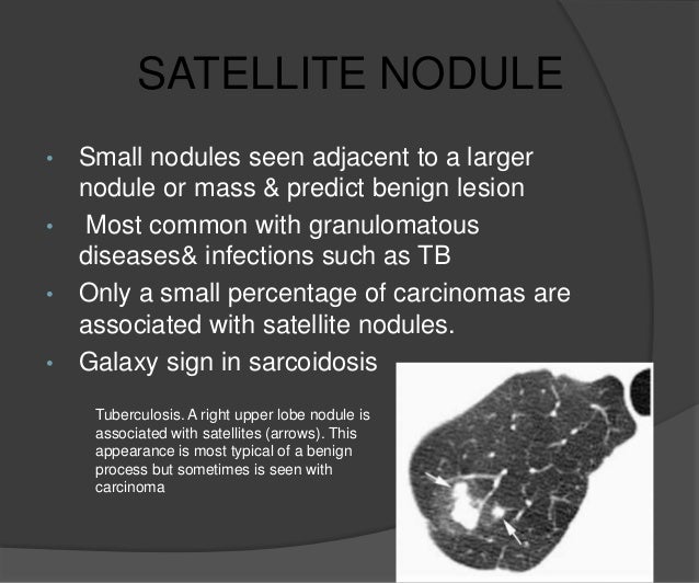 Solitary pulmonary nodule