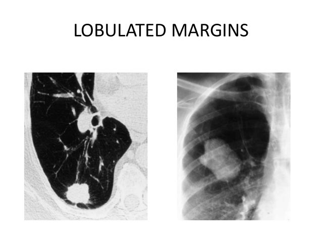 What Does Lobulated Nodule Mean - slidesharetrick