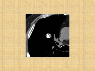 Solitary pulmonary nodule | PPT