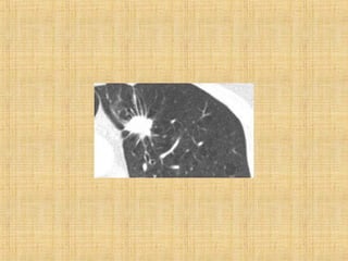 Solitary pulmonary nodule | PPT