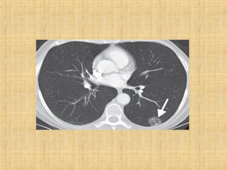 Solitary pulmonary nodule | PPT