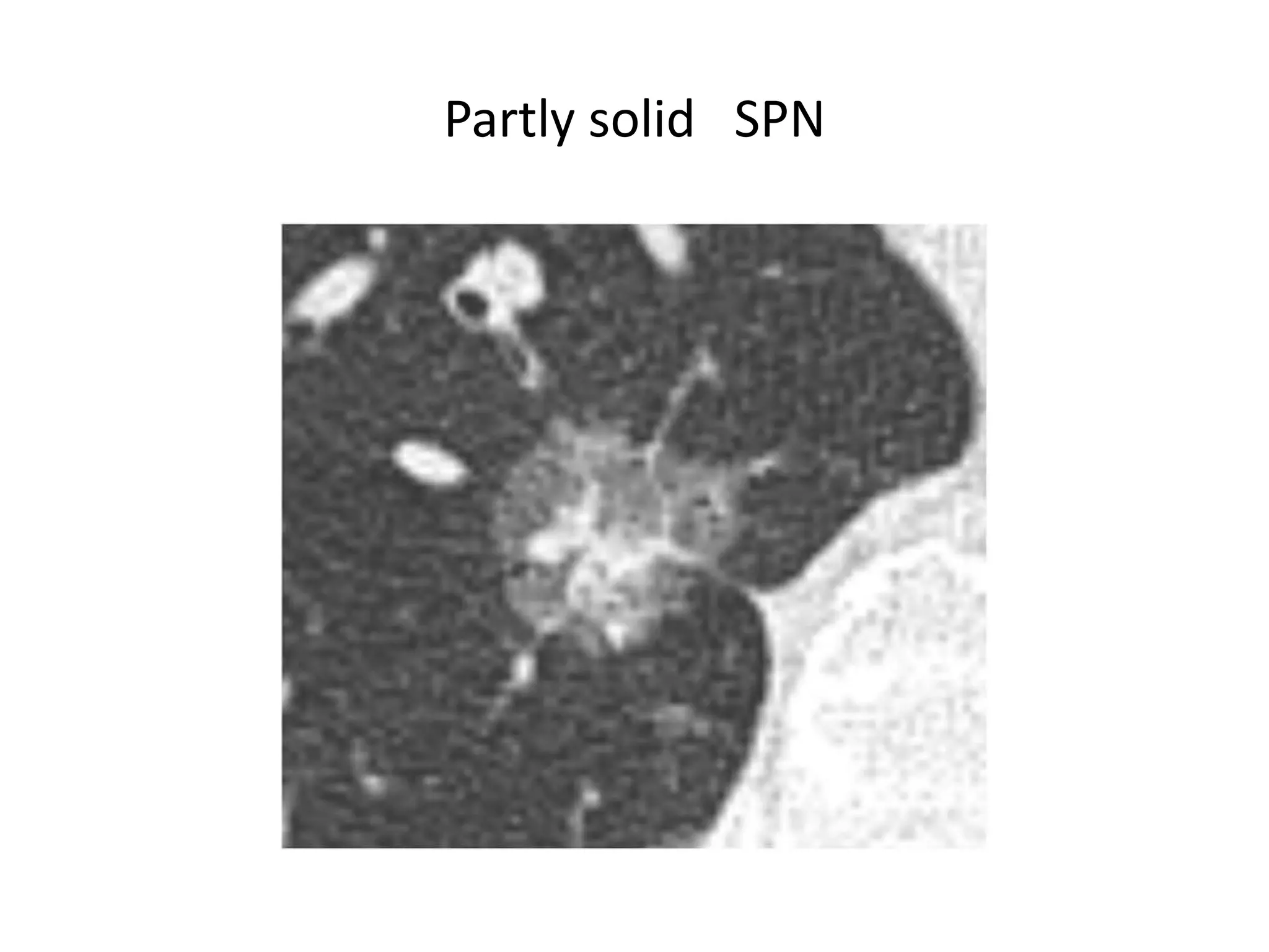 Solitary pulmonary nodule | PPTX