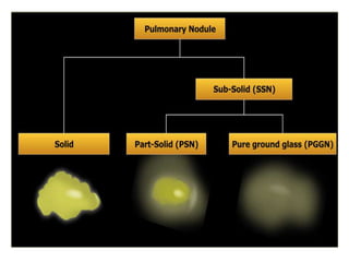 Solitary pulmonary nodule | PPTX