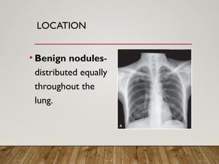 Solitary Pulmonary Nodule radiology department | PPTX