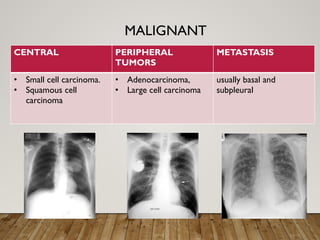 Solitary Pulmonary Nodule radiology department | PPTX