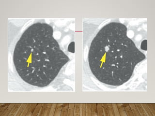 Solitary Pulmonary Nodule radiology department | PPTX