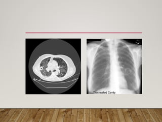 Solitary Pulmonary Nodule radiology department | PPTX