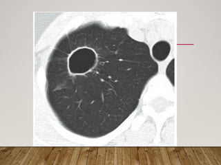 Solitary Pulmonary Nodule radiology department | PPTX