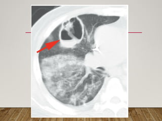 Solitary Pulmonary Nodule radiology department | PPTX