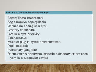 Solitary Pulmonary Nodule radiology department | PPTX