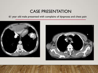 Solitary Pulmonary Nodule radiology department | PPTX