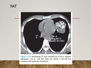 Solitary Pulmonary Nodule radiology department | PPTX