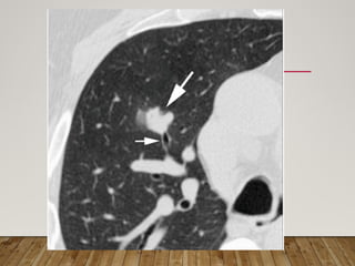 Solitary Pulmonary Nodule radiology department | PPTX