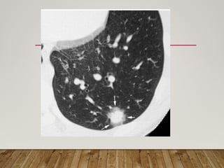 Solitary Pulmonary Nodule radiology department | PPTX