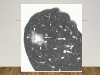 Solitary Pulmonary Nodule radiology department | PPTX