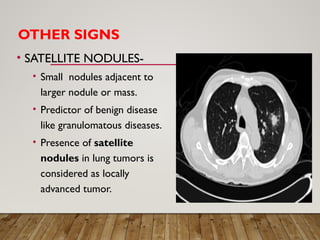 Solitary Pulmonary Nodule radiology department | PPTX