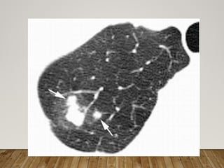 Solitary Pulmonary Nodule radiology department | PPTX