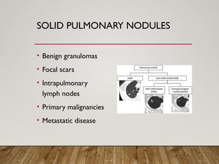 Solitary Pulmonary Nodule radiology department | PPTX