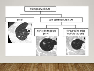 Solitary Pulmonary Nodule radiology department | PPTX