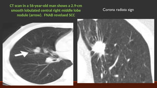Solitary Pulmonary Nodule: Diagnosis and Management (Fleischner Society ...