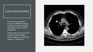 Popcorn Infection Understanding Solitary pulmonary nodules.pptx
