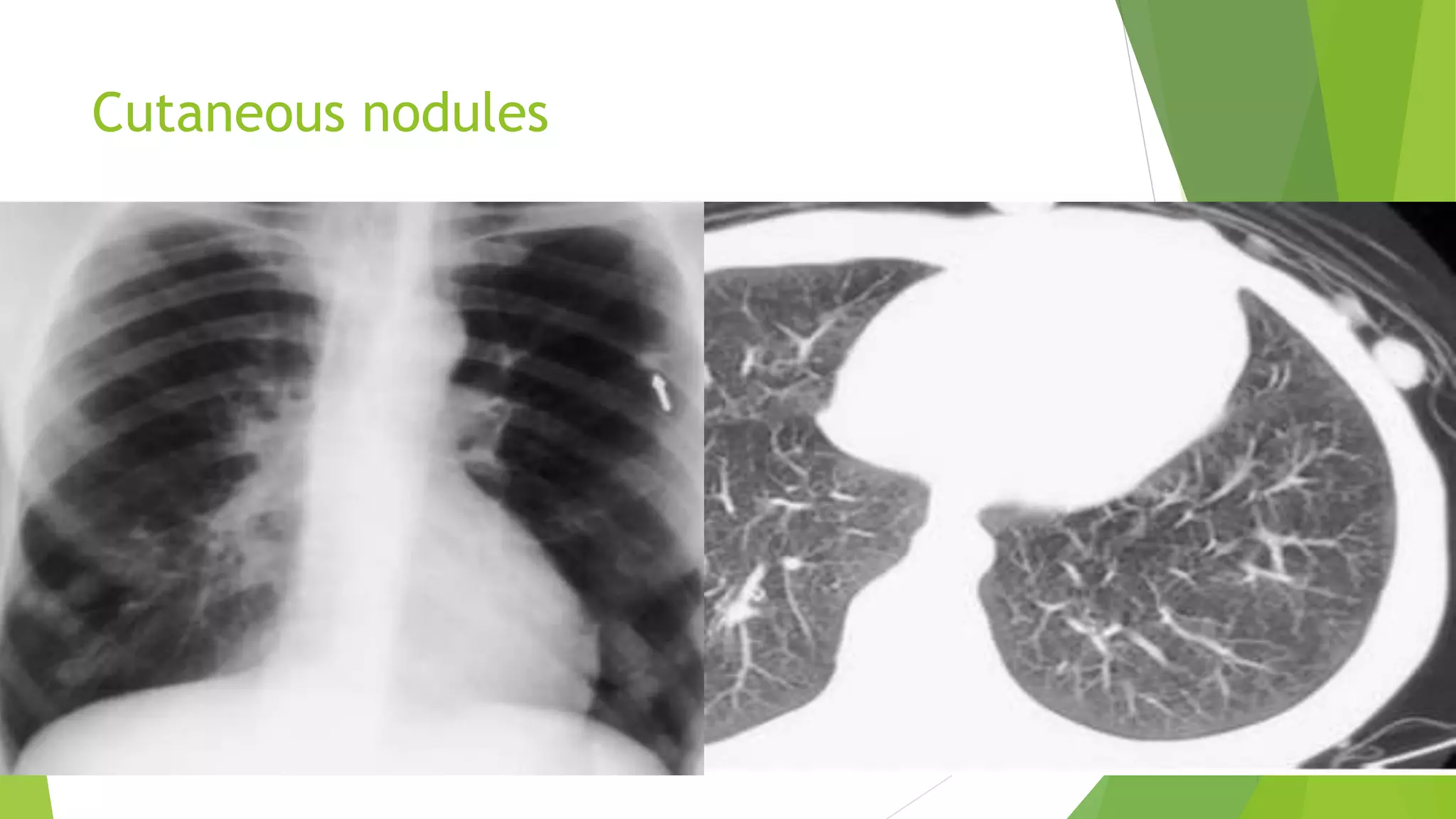 Solitary pulmonary nodules radiology pk ppt | PPTX
