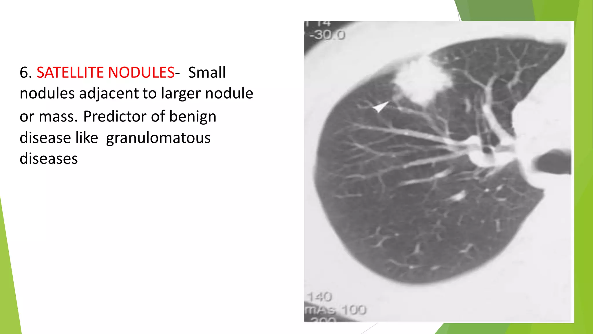 Solitary pulmonary nodules radiology pk ppt | PPTX