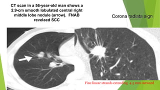Solitary pulmonary nodules radiology pk ppt | PPTX