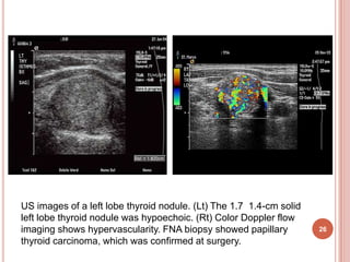 Solitary Thyroid Nodule | PPTX