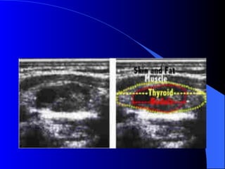 Solitary thyroid nodule | PPT