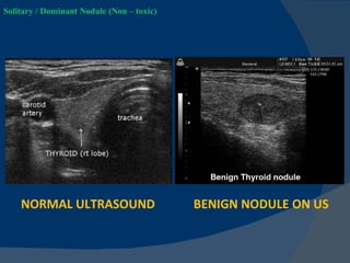 Solitary thyroid nodule ppt by dr koorapati ramesh | PPT