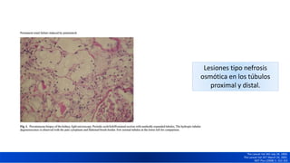 Lesiones tipo nefrosis
osmótica en los túbulos
proximal y distal.
The Lancet Vol 342 July 24, 1993.
The Lancet Vol 357 March 24, 2001.
NDT Plus (2008) 5: 322-325
 