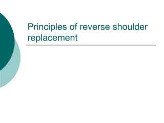 Principles of reverse shoulder
replacement
 