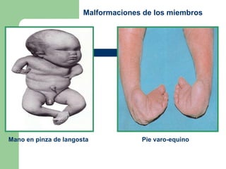 Mano en pinza de langosta Pie varo-equino  Malformaciones de los miembros 