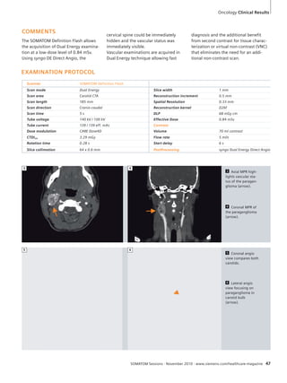 diagnosis and the additional benefit 
from second contrast for tissue charac-terization 
or virtual non-contrast (VNC) 
that eliminates the need for an addi-tional 
non-contrast scan. 
3 Axial MPR high-lights 
vascular sta-tus 
of the paragan-glioma 
(arrow). 
4 Coronal MPR of 
the paraganglioma 
(arrow). 
5 Coronal angio 
view compares both 
carotids. 
6 Lateral angio 
view focusing on 
paraganglioma in 
carotid bulb 
(arrow). 
cervical spine could be immediately 
hidden and the vascular status was 
immediately visible. 
Vascular examinations are acquired in 
Dual Energy technique allowing fast 
3 4 
SOMATOM Sessions · November 2010 · www.siemens.com/healthcare-magazine 47 
COMMENTS 
The SOMATOM Definition Flash allows 
the acquisition of Dual Energy examina-tion 
at a low-dose level of 0.84 mSv. 
Using syngo DE Direct Angio, the 
EXAMINATION PROTOCOL 
Scanner SOMATOM Definition Flash 
Scan mode Dual Energy Slice width 1 mm 
Scan area Carotid CTA Reconstruction increment 0.5 mm 
Scan length 185 mm Spatial Resolution 0.33 mm 
Scan direction Cranio-caudal Reconstruction kernel D26f 
Scan time 5 s DLP 68 mGy cm 
Tube voltage 140 kV / 100 kV Effective Dose 0.84 mSv 
Tube current 139 / 139 eff. mAs Contrast 
Dose modulation CARE Dose4D Volume 70 ml contrast 
CTDIvol 3.29 mGy Flow rate 5 ml/s 
Rotation time 0.28 s Start delay 6 s 
Slice collimation 64 x 0.6 mm PostProcessing syngo Dual Energy Direct Angio 
5 6 
Oncology Clinical Results 
 