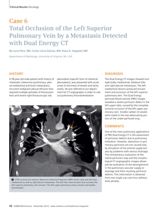 Clinical Results Oncology 
Case 6 
Total Occlusion of the Left Superior 
Pulmonary Vein by a Metastasis Detected 
with Dual Energy CT 
By Lucía Flors, MD, Carlos Leiva-Salinas, MD, Klaus D. Hagspiel, MD 
Department of Radiology, University of Virginia, VA, USA 
HISTORY 
A 58-year-old male patient with history of 
metastatic melanoma (pulmonary, pleu-ral 
mediastinal and brain metastases), 
recurrent malignant pleural effusion that 
required multiple episodes of thoracocen-tesis 
and recent right thoracoscopic talc 
pleurodesis (specific form of chemical 
pleurodesis), was presented with acute 
onset of shortness of breath and tachy-cardia. 
He was referred to our depart-ment 
for CT angiography in order to rule 
out pulmonary thromboembolism. 
1 CTPA coronal sub-volume, Maximum Intensity Projection (MIP) shows right and left hilar, 
mediastinal as well as right pleural metastases. The left hilar mass encases and occludes the 
left superior pulmonary vein (arrow). The left upper pulmonary artery remains permeable 
(arrowhead). 
48 SOMATOM Sessions · November 2010 · www.siemens.com/healthcare-magazine 
DIAGNOSIS 
The Dual Energy CT images showed mul-tiple 
bulky mediastinal, bilateral hilar 
and right pleural metastases. The left 
mediastinal lesions produced encase-ment 
and occlusion of the left superior 
pulmonary vein. The Dual Energy 
perfused blood volume (PBV) images 
revealed a severe perfusion defect in the 
left upper lobe, caused by the complete 
tumoral occlusion of the left upper pul-monary 
vein. Smaller caliber of vessels 
were noted in the low-attenuating por-tion 
of the under-perfused lung. 
COMMENTS 
One of the main pulmonary applications 
of PBV Dual Energy CT is the assessment 
of perfusion defects due to pulmonary 
embolism. However, alterations in pul-monary 
perfusion are not caused only 
by disruption of the arterial supply but 
also by problems with venous drainage. 
The simultaneous evaluation of the 
iodine perfusion map and the morpho-logical 
CT angiographic images allows 
precise evaluation of the derangements 
in the pulmonary vascular supply or 
drainage and their resulting perfusion 
defects. This information is obtained 
from one single scan and thus without 
dose penalty. 
1 
 