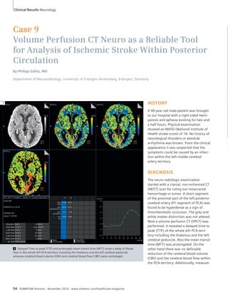 Case 9 
Volume Perfusion CT Neuro as a Reliable Tool 
for Analysis of Ischemic Stroke Within Posterior 
Circulation 
By Philipp Gölitz, MD 
Department of Neuroradiology, University of Erlangen-Nuremberg, Erlangen, Germany 
54 SOMATOM Sessions · November 2010 · www.siemens.com/healthcare-magazine 
HISTORY 
A 90-year old male patient was brought 
to our hospital with a right-sided hemi-paresis 
and aphasia existing for two and 
a half hours. Physical examination 
showed an NIHSS (National Institute of 
Health stroke score) of 18. No history of 
neurological disorders or absolute 
arrhythmia was known. From the clinical 
appearance it was suspected that the 
symptoms could be caused by an infarc-tion 
within the left middle cerebral 
artery territory. 
DIAGNOSIS 
The neuro-radiologic examination 
started with a cranial, non-enhanced CT 
(NECT) scan for ruling out intracranial 
hemorrhage or tumor. A short segment 
of the proximal part of the left posterior 
cerebral artery (P1-segment of PCA) was 
found to be hyperdense as a sign of 
thrombembolic occlusion. The grey and 
white matter distinction was not altered. 
Next a volume perfusion CT (VPCT) was 
performed. It revealed a delayed time to 
peak (TTP) of the whole left PCA-terri-tory 
including the thalamus and the left 
cerebral peduncle. Also the mean transit 
time (MTT) was prolongated. On the 
other hand there was no definable 
reduction of the cerebral blood volume 
(CBV) and the cerebral blood flow within 
the PCA-territory. Additionally, measure- 
1 Delayed Time to peak (TTP) and prolonged mean transit time (MTT) show a delay of blood 
flow in the whole left PCA-territory including the thalamus and the left cerebral peduncle 
whereas cerebral blood volume (CBV) and cerebral blood flow (CBF) were unchanged. 
1 
Clinical Results Neurology 
 