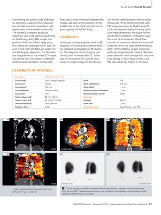Now, only a small mismatch between the 
images was seen at the periphery of the 
middle lobe of the right lung and the lin-gular 
segment of the left lung. 
COMMENTS 
In the past, scintigraphy was used for PE 
diagnosis. In recent years however MDCT 
has replaced scintigraphy for PE diagno-sis. 
The diagnosis can be done by con-firming 
clots in vessels with CT. In the 
case of this patient, PE could be diag-nosed 
on single Energy CT, but the rea-son 
Acute Care Clinical Results 
for the improvement of clinical symp-toms 
could not be confirmed. Only with 
PBV images acquired by Dual Energy CT 
could we presume that pulmonary perfu-sion 
improvement was the cause for the 
relief of the symptoms. Perhaps this was 
the result of an increased blood flow 
around the thrombus, which was too small 
to be seen from the state of the thrombus 
itself. Only functional images (meaning 
perfusion images) could reveal it. We were 
able to see this small change with only one 
Dual Energy CT scan. Dual Energy Lung 
PBV was extremely helpful in this case. 
3A 3B 
SOMATOM Sessions · November 2010 · www.siemens.com/healthcare-magazine 57 
Considering the patient’s age and physi-cal 
condition, a wait-and-see approach 
was decided and anti-coagulation with 
heparin and warfarin were continued. 
The patient’s symptoms gradually 
improved. One week later we confirmed 
on Dual Energy Lung PBV images that 
perfusion had improved in large parts, 
but slightly decreased perfusion was still 
seen in the mid-right lobe and upper left 
and left lingular segments. The thrombus 
had disappeared on the mixed CT images. 
Two weeks later, the patient underwent 
perfusion and ventilation scintigraphy. 
EXAMINATION PROTOCOL 
Scanner SOMATOM Definition 
Scan mode Dual Energy Lung PBV Pitch 0.8 
Scan area Thorax Slice collimation 0.6 mm 
Scan length 290 mm Slice width 1 mm 
Scan direction Cranio-caudal Reconstruction increment 1 mm 
Scan time 6.9 s Reconstruction kernel D30f 
Tube voltage A/B 80 kV / 140 kV Contrast 
Tube current A/B 45 mAs / 225mAs Volume 60 ml 
Dose modulation CARE Dose4D Flow rate 2 ml/s 
Rotation time 0.33 s Postprocessing Dual Energy Lung PBV 
3C 3D 
… but a considerable improvement of lung 
perfusion (Fig. 2C and 2D). 
3 CT Dual Energy Lung PBV one week later showed almost complete perfusion recovery 
(Fig. 3A and 3B). 2 weeks later perfusion and ventilation scintigraphy unveiled only a small 
remaining defect (Fig. 3C and 3D). 
2B 
2D 
16:30 1 week later 1 week later 
16:30 2 weeks later 2 weeks later 
 