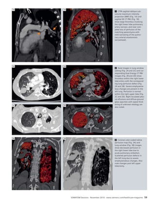 2 Axial images in lung window 
setting (Fig. 2A and 2C) and cor-responding 
Dual Energy CT PBV 
images (Fig. 2B and 2D) show 
thrombus within the right lower 
lobe artery with the correspond-ing 
lung perfusion defect (Fig. 
2A and 2B). Severe emphysema-tous 
changes are present in the 
left lung. Perfusion is normal 
within the right upper lobe (Fig. 
2C and 2D). Right loculated pleu-ral 
effusions and diffuse ground 
glass opacities with septal thick-ening 
of unknown etiology are 
also noted. 
SOMATOM Sessions · November 2010 · www.siemens.com/healthcare-magazine 59 
2A 2B 
2C 2D 
3 Coronal color-coded iodine 
perfusion map (Fig. 3A) and 
lung window (Fig. 3B) images 
show decreased perfusion in 
the right lower lobe due to 
acute pulmonary embolism. 
Scattered perfusion defects in 
the left lung due to severe 
emphysematous changes. Also 
note changes post left upper 
lobectomy. 
3A 3B 
1 CTPA sagittal-oblique sub-volume 
maximum intensity 
projection (MIP) (Fig. 1A) and 
sagittal DE CT PBV (Fig. 1B) 
show large thrombus involving 
the right lower lobe pulmonary 
artery (arrow), and near com-plete 
loss of perfusion of the 
matching parenchyma with 
mild narrowing of the pulmo-nary 
arterial anastomosis 
(arrowhead). 
1A 1B 
 