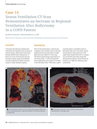 Clinical Results Pulmonology 
Case 14 
Xenon Ventilation CT Scan 
Demonstrates an Increase in Regional 
Ventilation After Bullectomy 
in a COPD Patient 
By Calvin Yeung W.H., MD and Gladys G. Lo, MD 
Department of Diagnostic and Interventional Radiology, Hong Kong Sanatorium and Hospital 
DIAGNOSIS 
Prior to the examination, a Xenon gas 
inhalation was initiated. Xenon was also 
applied during the acquisition to high-light 
perfusion defects in the lungs. 
The Xenon Dual Energy examination of 
the thorax (Figs. 1 and 2) showed dif-fuse 
emphysema and a large, 9 cm bulla 
in the left lower lobe. There was a signif-icant 
64 SOMATOM Sessions · November 2010 · www.siemens.com/healthcare-magazine 
decrease in ventilation seen in 
left lower lobe due to the bulla. Xenon 
enhancement measurements in left 
upper lobe showed 44% and in compari-son 
to the left lower lobe nearly 0% 
enhancement (Xenon enhancement at 
trachea is at 100% for reference mea-surements). 
HISTORY 
A 70-year-old male (ex-smoker) was 
referred to the hospital with a history of 
severe Chronic Obstructive Pulmonary 
Disease (COPD) with emphysema. A 
Xenon CT-scan of the thorax was per-formed 
to assess regional ventilation 
and plan bullectomy (either broncho-scopic 
or video assisted surgery). 
1 Coronal section of Xenon CT scan of the thorax before bullectomy 
shows marked decrease in regional ventilation in left lower lobe due 
to large bulla. 
2 Axial section of Xenon CT scan of thorax shows Xenon 
enhancement in left upper lobe. 
1 2 
 
